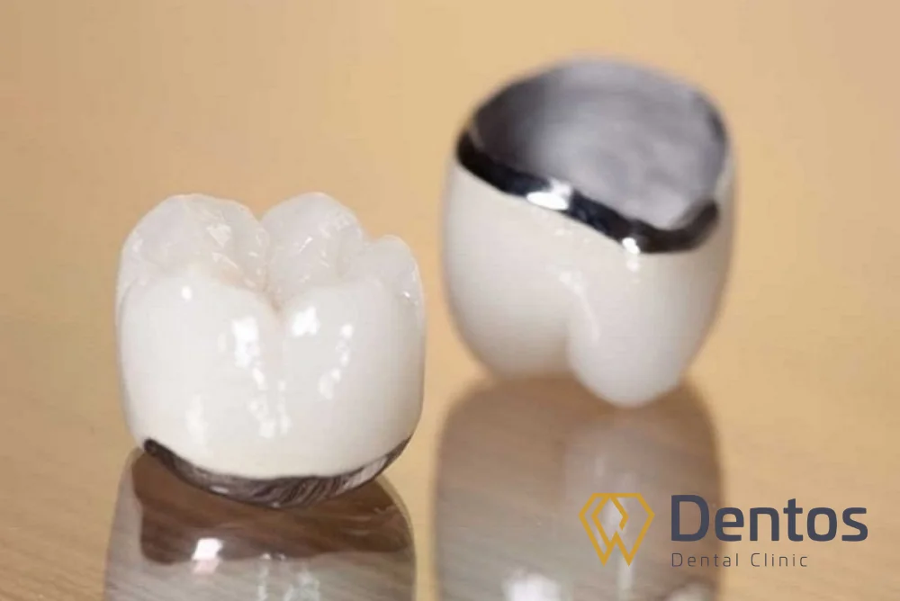 Răng sứ sườn kim loại dễ oxy hóa, gây đen viền nướu